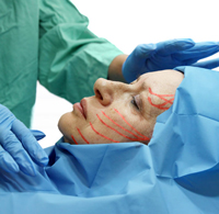 facelift